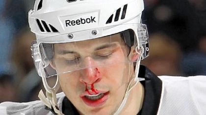 Sidney Crosby shows the effects of getting hit with a puck in the second period Thursday against the Islanders at Nassau Veterans Memorial Coliseum in Uniondale, N.Y.