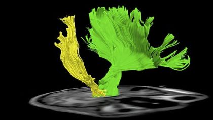 The brain image of Dan Stunkard shows how motor nerves on the right side of his brain, in yellow, are much more sparse after damage from an ATV accident than those on the left side, in green.