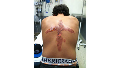 Result of the salt-and-ice challenge that sent a 12-year-old boy to West Penn Hospital's emergency room and burn center last weekend.