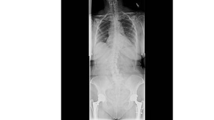 Dolores Grandizio's x-rays shwoing the curvature of her spine.