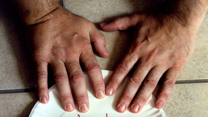 Chris Bauer's right hand shows symptoms of an attack of gout.