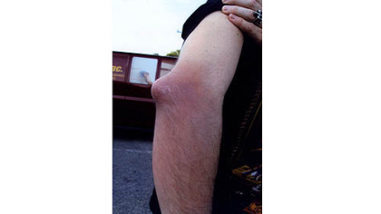 Chris Bauer's elbow after an attack of gout. The lump is tophi, an accumulation of uric acid under the skin.